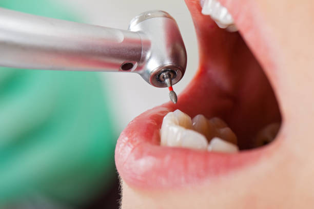 Best Emergency Wisdom Tooth Extraction in Lincoln Park, NJ